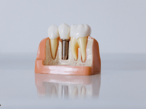 Single Tooth Implants vs. All-on-4: Which Option Fits Your Tooth Replacement Needs?