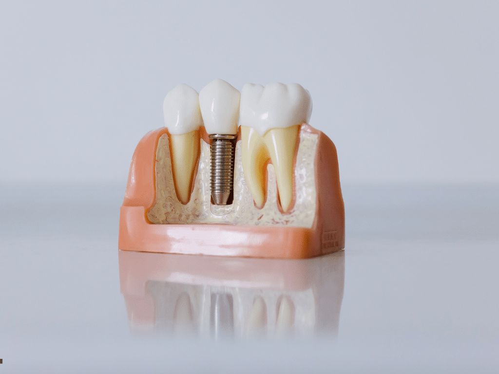 Single Tooth Implants vs. All-on-4 Which Option Fits Your Tooth Replacement Needs Single Tooth Implants vs. All-on-4 Which Option Fits Your Tooth Replacement Needs